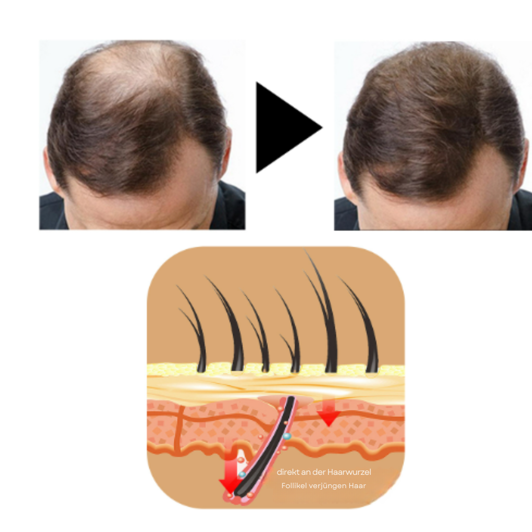 HairBoost™ | Ingen bare flekker lenger!
